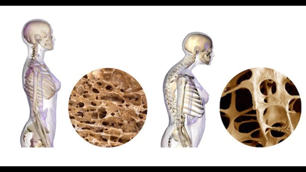 Остеопороз становится основной причиной переломов, изменений походки и болей в костях у женщин старше 55 лет. 