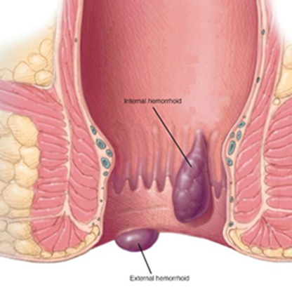 Внешние и внутренние геморроидальные узлы