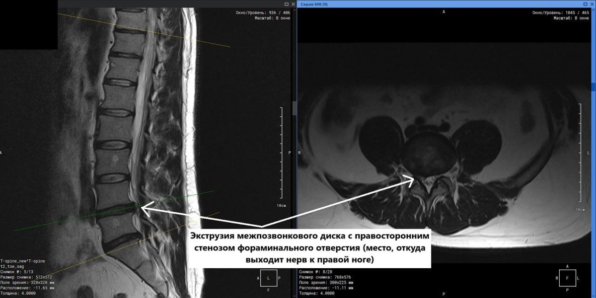 МРТ пояснично-крестцового-копчикового отдела позвоночника пациента 34 лет с жалобами на боль в спине и правой ноге