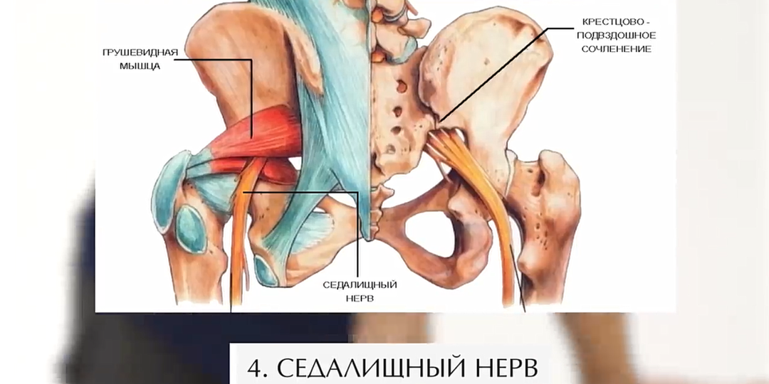 Защемление седалищного нерва можно убрать за 1-2 сеанса!