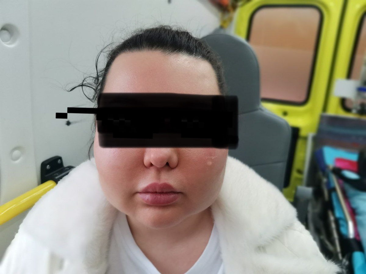 отек век (закрашено), щёк и губ при аллергической реакции (отёк Квинке)