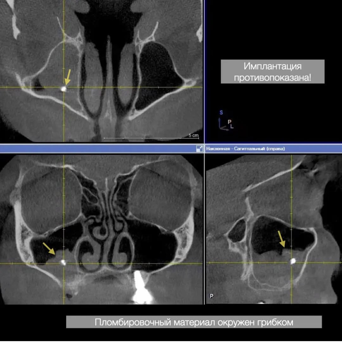 Инородное тело (пломбировочный материал) в пазухе - хирургические манипуляции противопоказаны