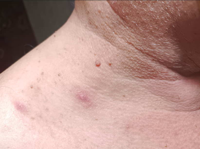 две болячки почернели и отвалились