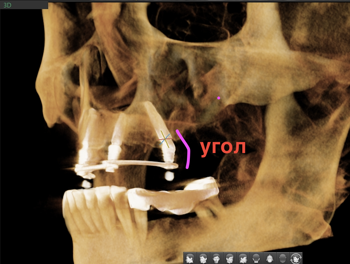 "Всё-на-4", имплантат под углом, угловой мультиюнит