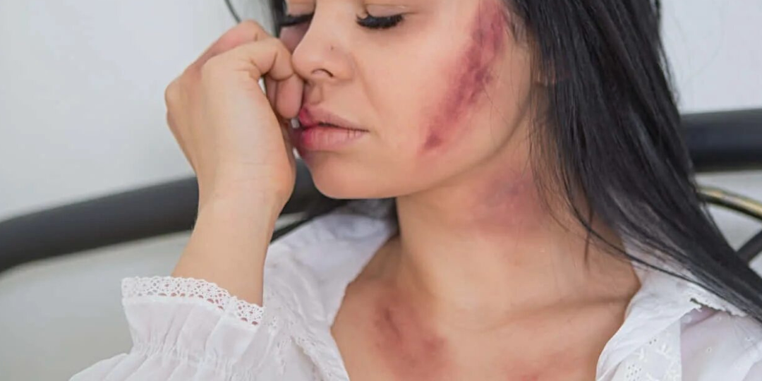 Невестка пришла к нам в синяках, сказала: "Упала с лестницы!" Что рассказал нам внук?