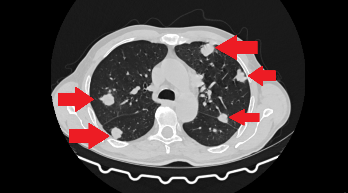 Множественное метастатическое поражение легких. Компьютерная томография.
