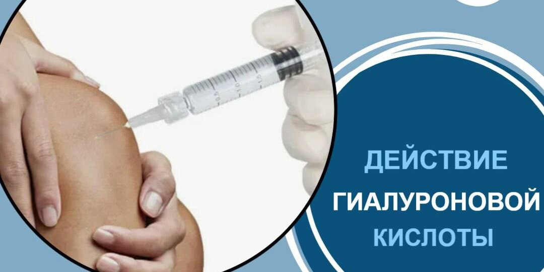 Гиалуроновая кислота для суставов: «жидкий протез» или временное спасение? Объясняет ортопед