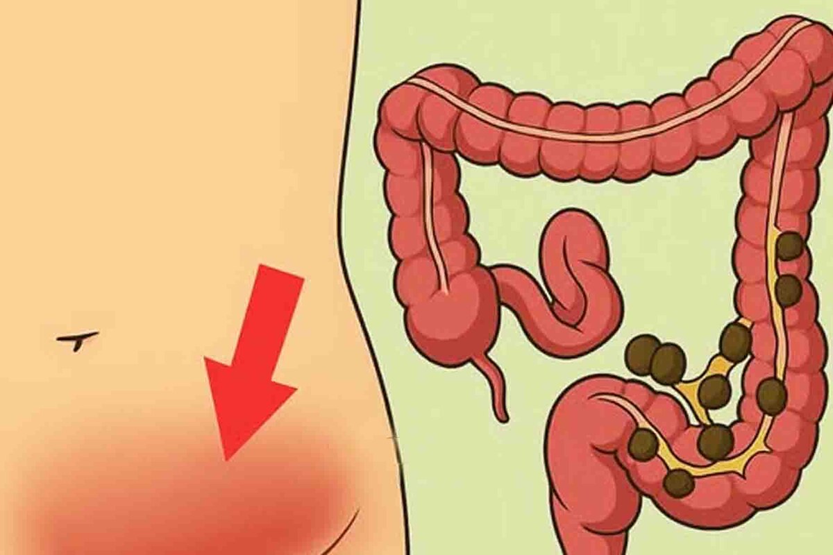 Когда Вздутие И Газы — Первые Признаки Опухоли Кишечника