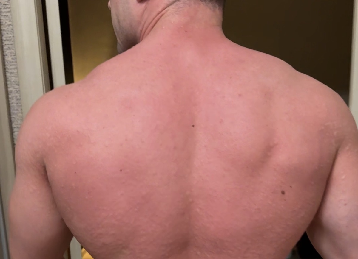 Кожный зуд без видимой сыпи