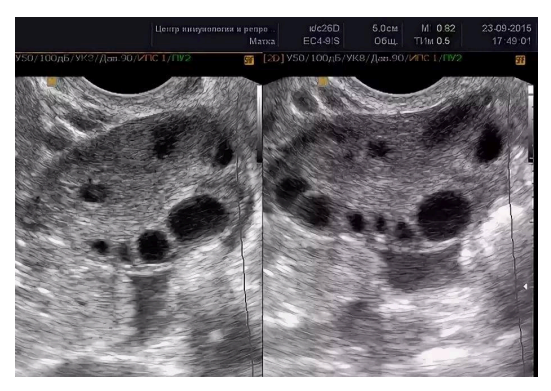 Яичники на УЗИ в 25 лет