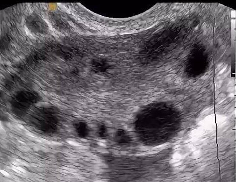 Много фолликулов - высокий АМГ