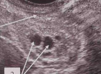 Мало фолликулов - низкий АМГ