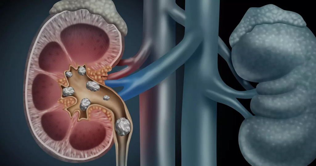 Есть ли связь между гипотиреозом и камнями в почках?