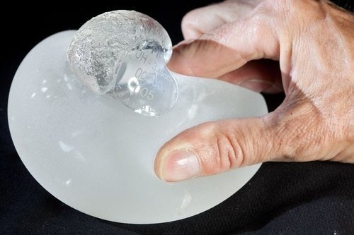 Разрыв силиконового импланта. Источник: https://doctor-osin.ru/stati/razryv-implanta-grudi-prichiny-posledstviya-i-sposoby-resheniya/