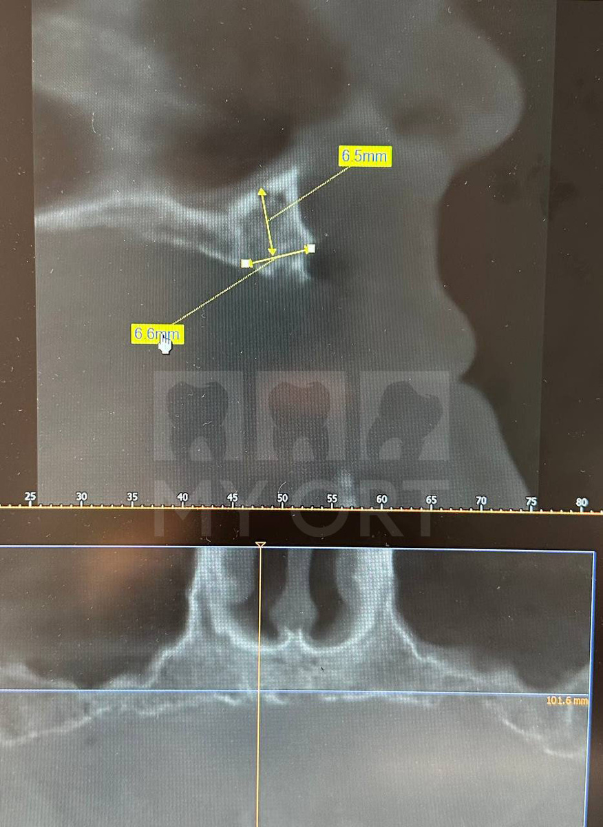 Дефицит костной ткани в передних и боковых отделах верхней челюсти