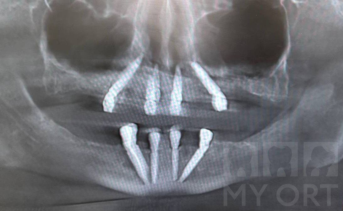 Установка имплантатов. Снимок (КТ)