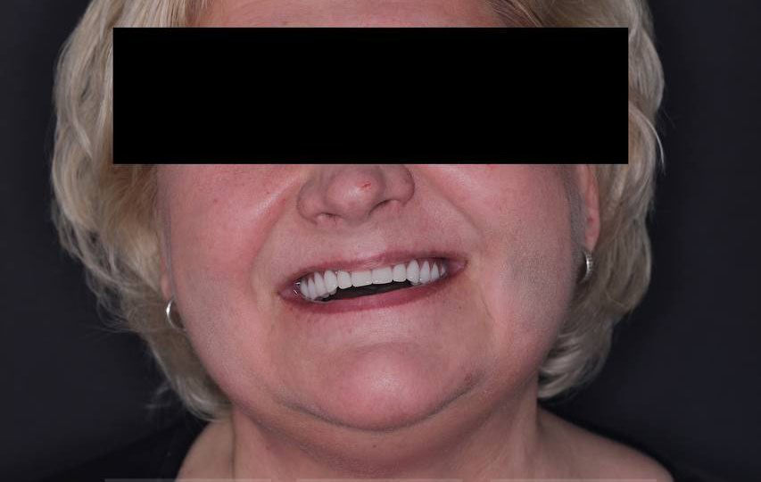 Восстановление зубов при дефиците кости по протоколу All-on-4. Сложный случай имплантации