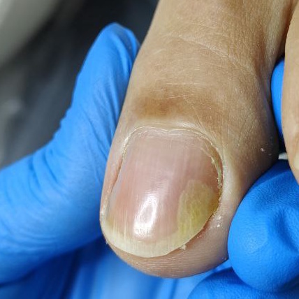 Пример, когда сразу необходимо идти к подологу, такой ноготь самостоятельно не получится восстановить. 