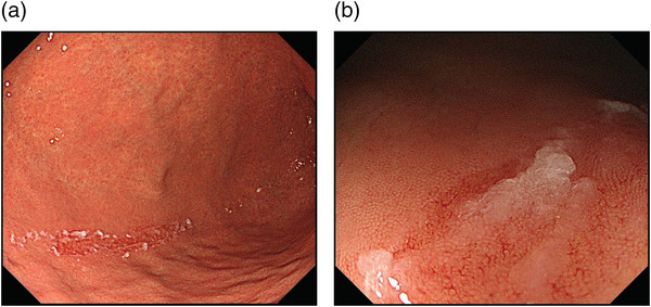«Царапина» от прохождения эндоскопа, или scratch sign, в области большой кривизны желудка — возможный признак отсутствия H. pilory. По материалам Yada et al.