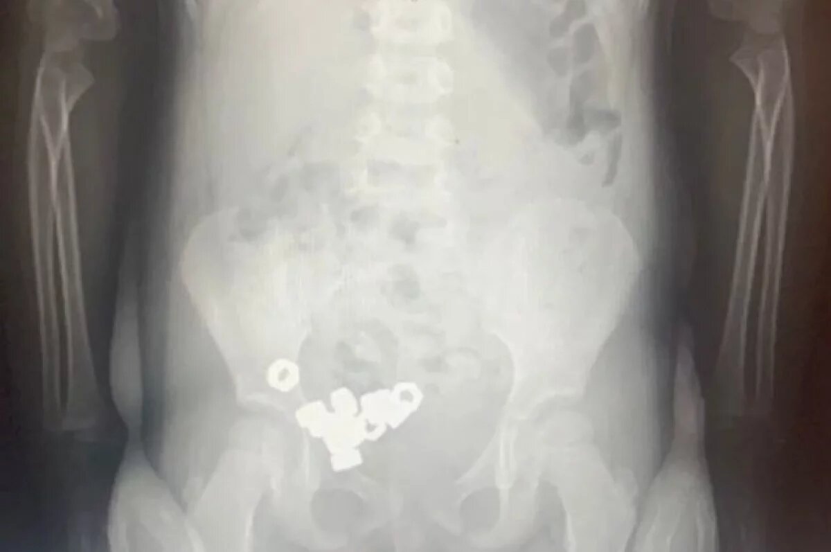    Трёхлетний малыш из Воронежа проглотил 16 гаек