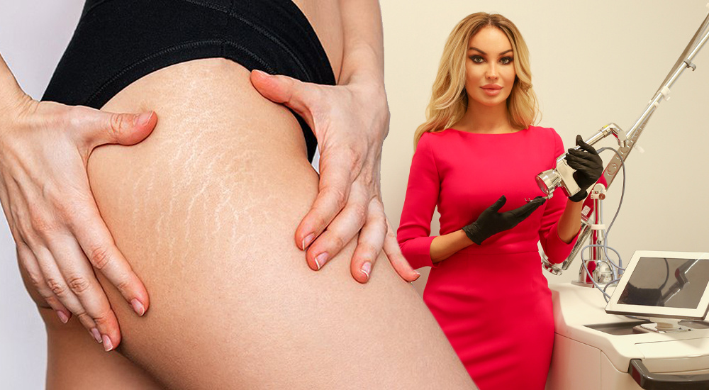 В основном растяжки возникают из-за чрезмерного растяжения кожи на отдельных её участках