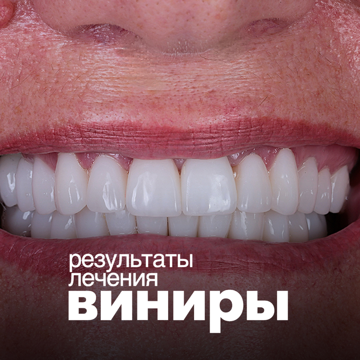 Сегодня кейс прекрасной пациентки 60-ти лет