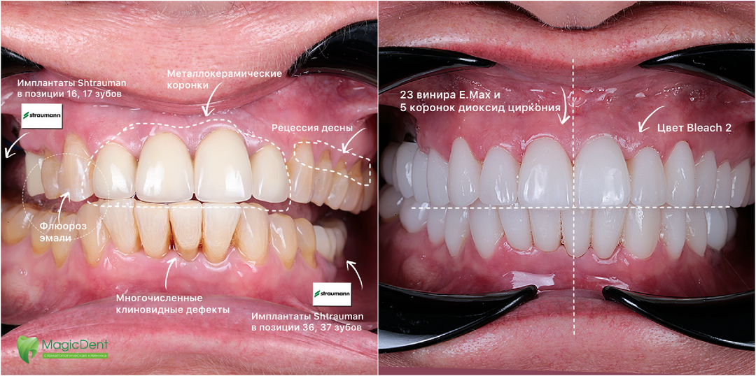 В 60 лет ваша улыбка может засиять абсолютно по-новому!
