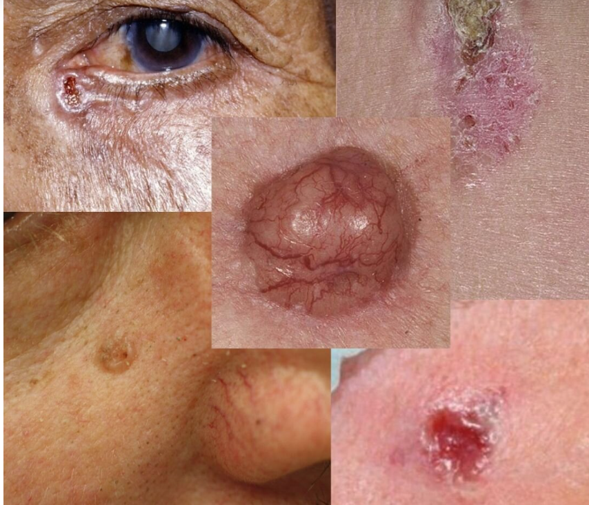 Так выглядит базально-клеточный рак 