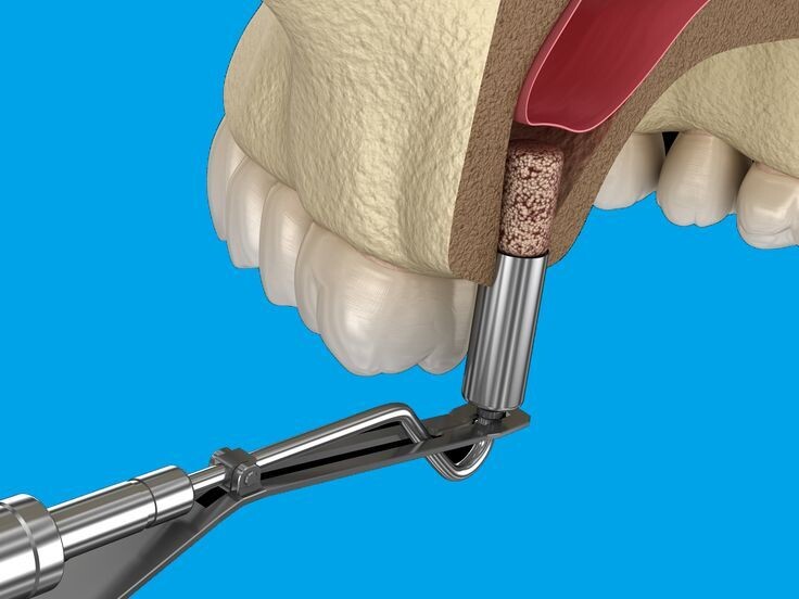 Закрытый синус-лифтинг