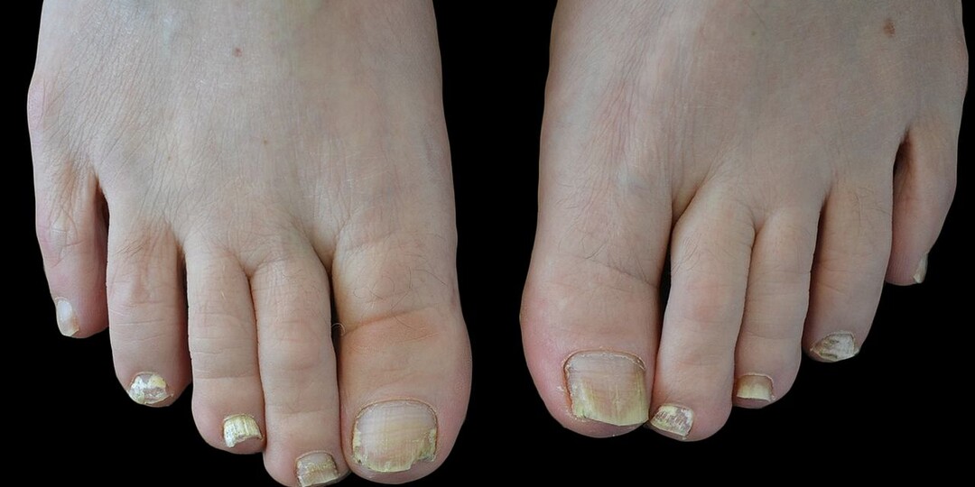 Грибок ногтей — не просто косметический дефект: почему игнорировать его опасно, и как вернуть ногтям здоровье