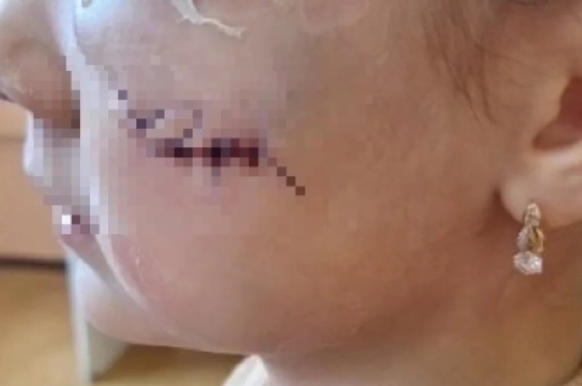    Девочке, разорвавшей щёку в игровой в Челябинске, снимут швы 20 ноября