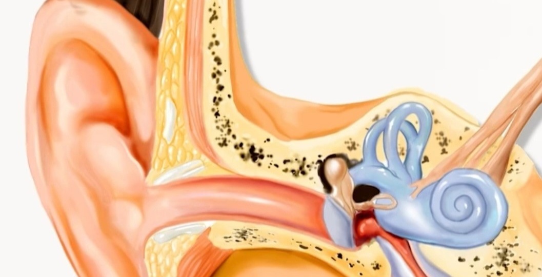 Шум в ушах — от нервов, сосудов или уха? Как снизить шум в ушах