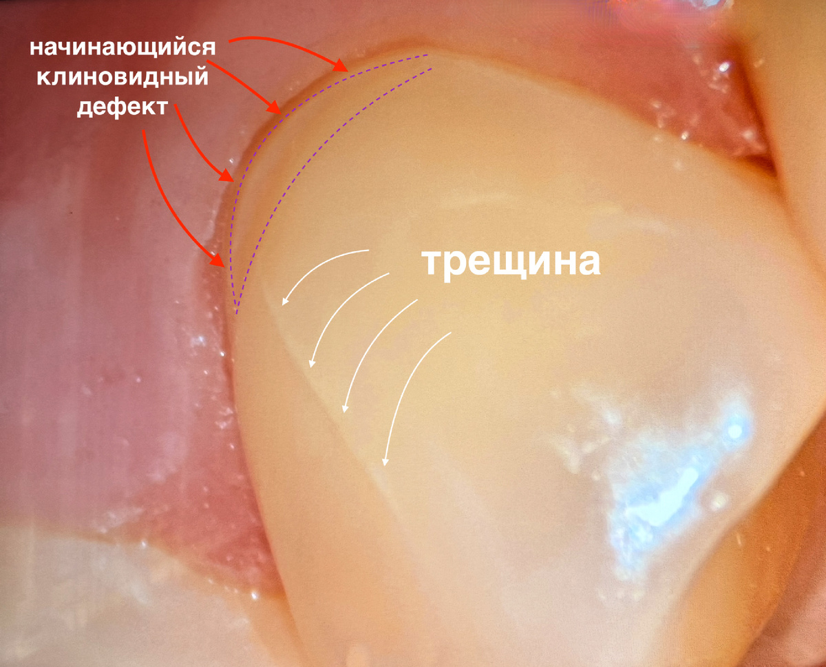 Начинающийся клиновидный дефект