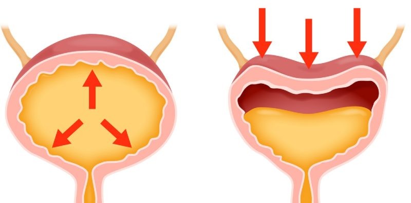 8 утренних признаков проблем с мочевым пузырём (чек-лист)