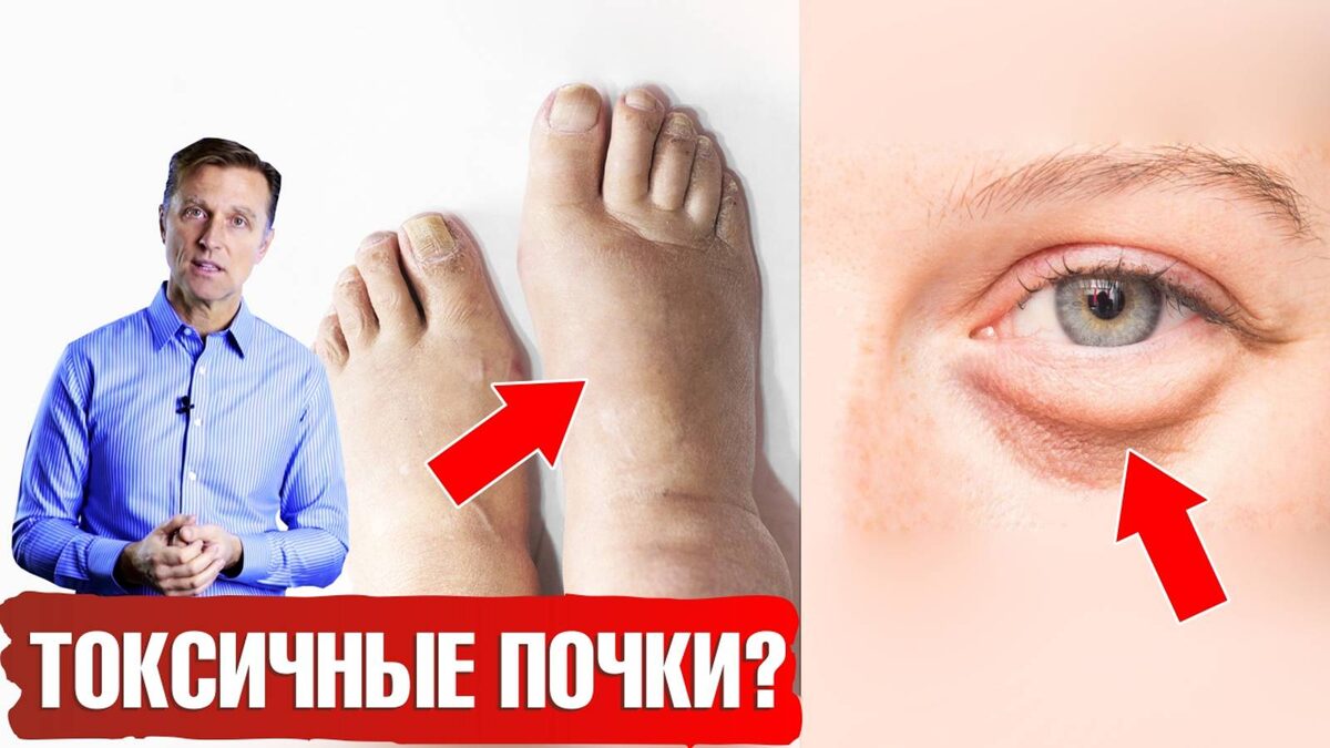 5 Причин Отёков, Которые Связаны Не С Сердцем, А С Почками (Чек-Лист)