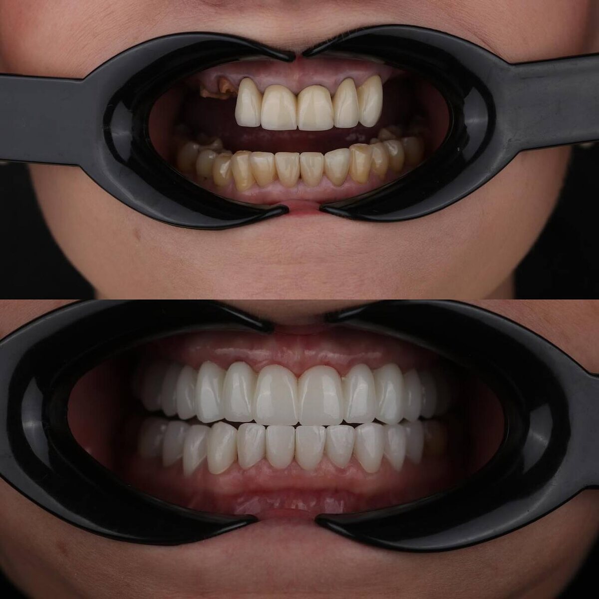 Все на 6 верх- протез из диоксида циркония без исскуственной десны и частичная имплантация  низ