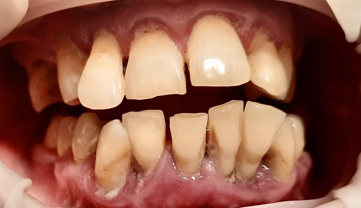 Пародонтит на стадии, когда спасти все зубы не удастся