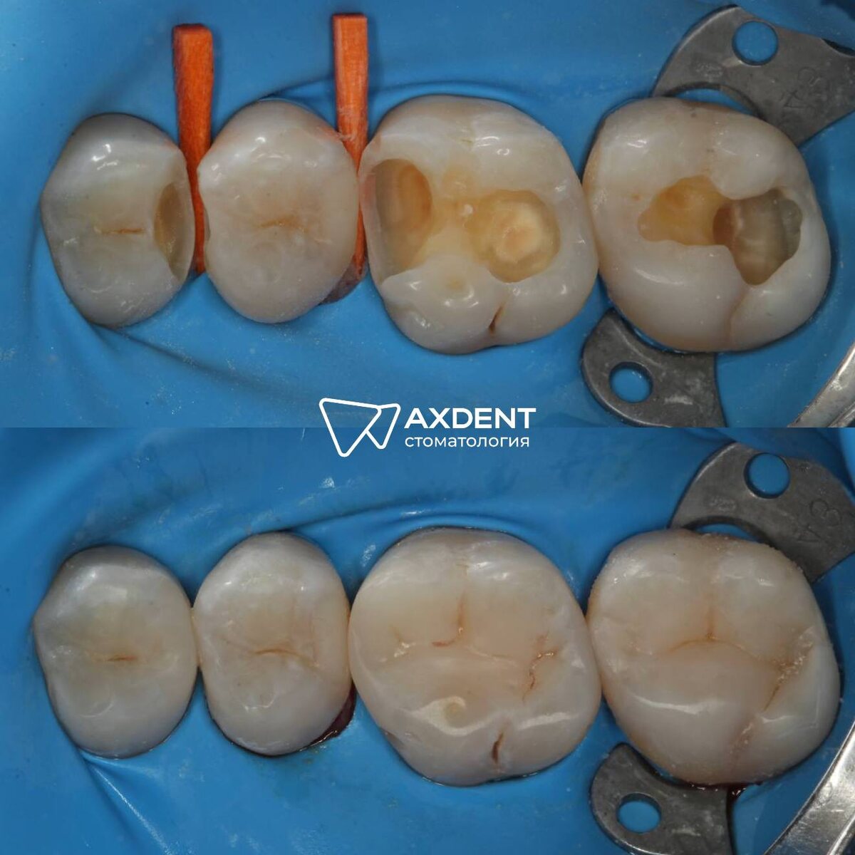 Кариес на контакте был незаметен пациенту