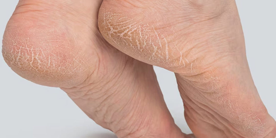 Из-за чего трескаются пятки