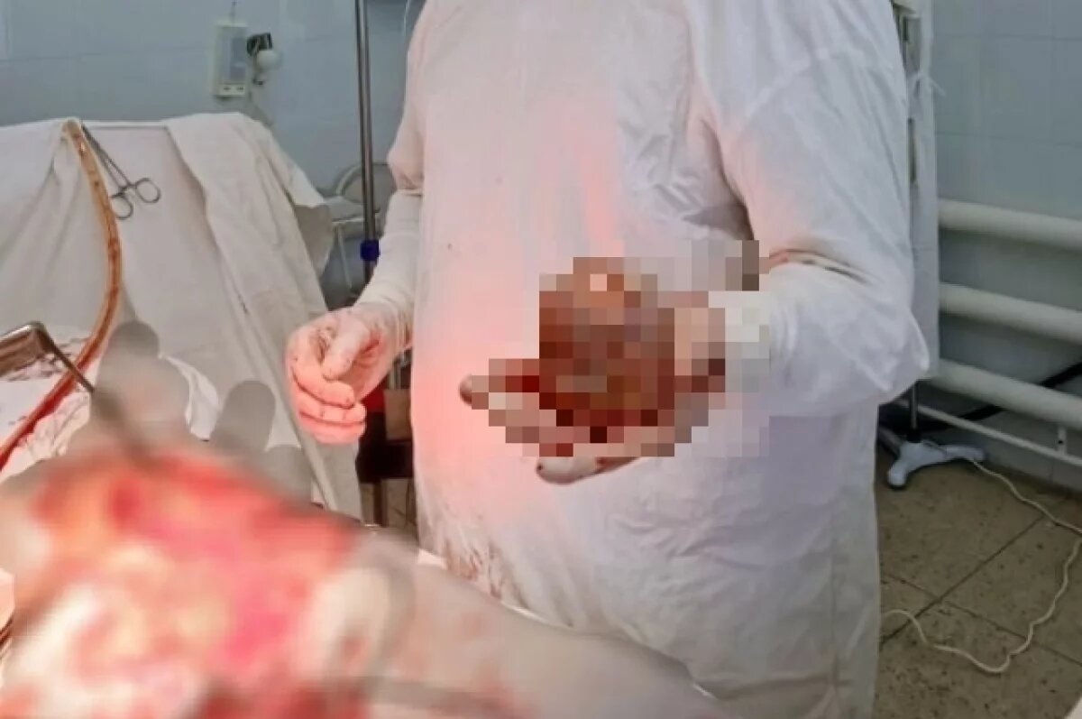    Саратовские врачи извлекли из мочевого пузыря килограммовый камень