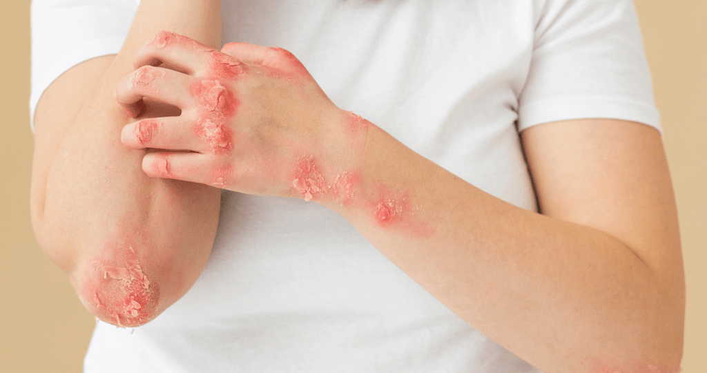 Как лечить псориаз? Работают ли народные средства?