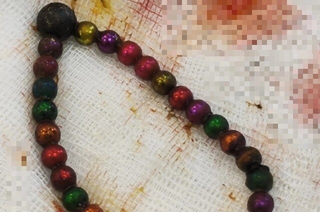    30 ярких шариков едва не унесли жизнь малыша. Риск был достаточно высокий. Фото: Министерство здравоохранения Рязанской области