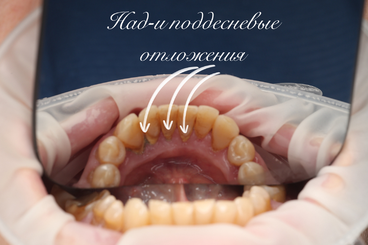 Внутриротовые фото «ДО»