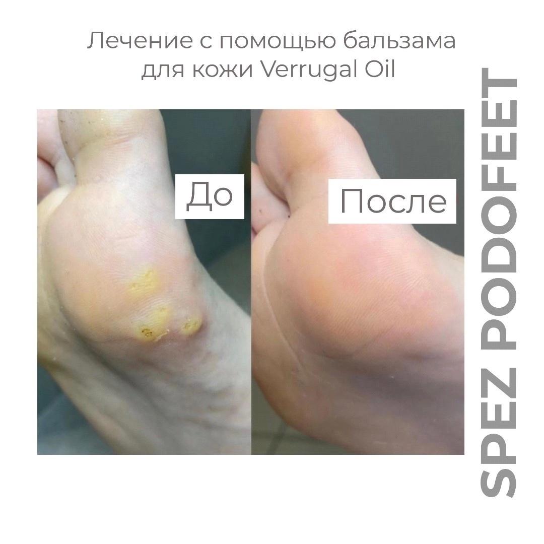В карусели динамики применения бальзама Verrugal Oil, предоставленных практикующими подологами
