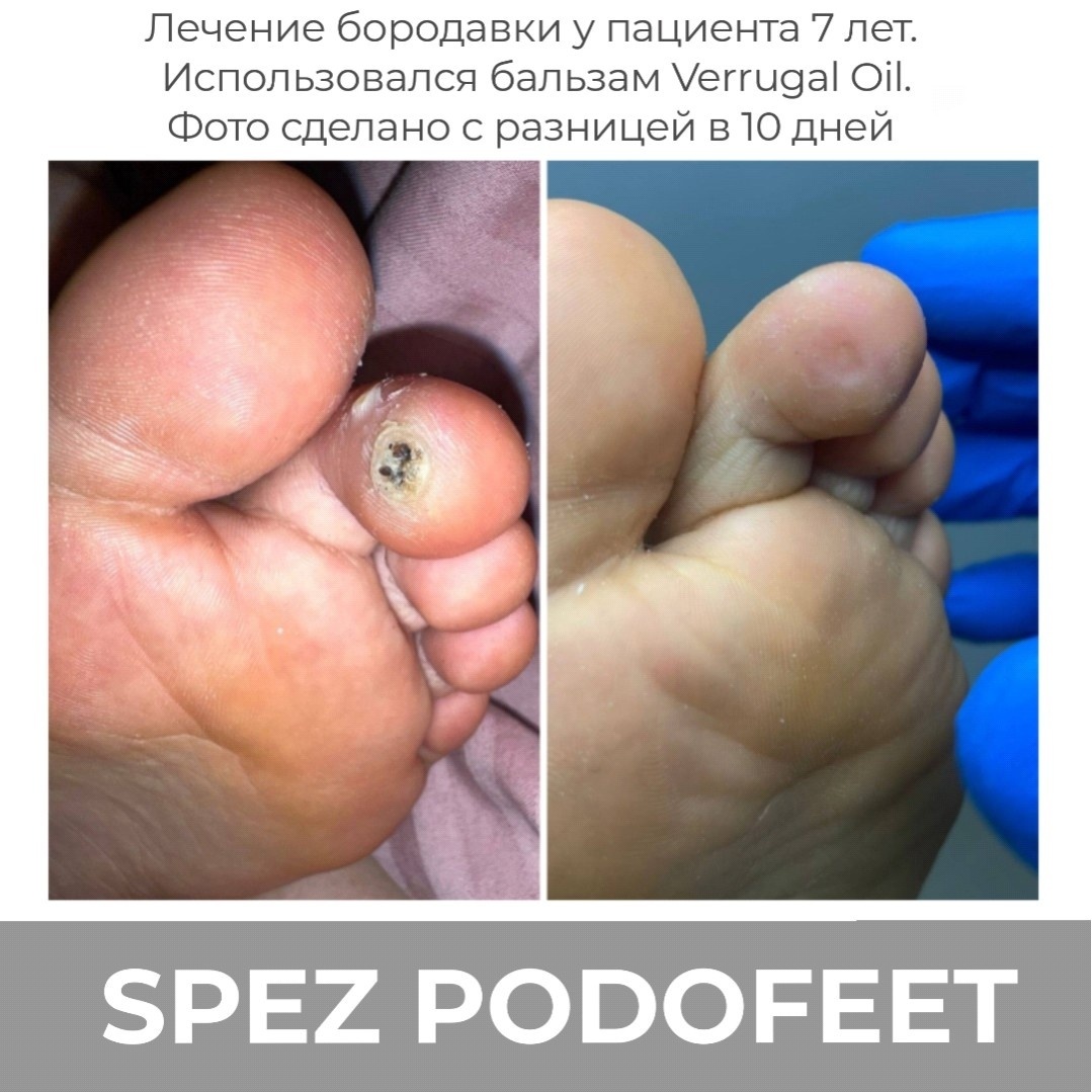 В карусели динамики применения бальзама Verrugal Oil, предоставленных практикующими подологами