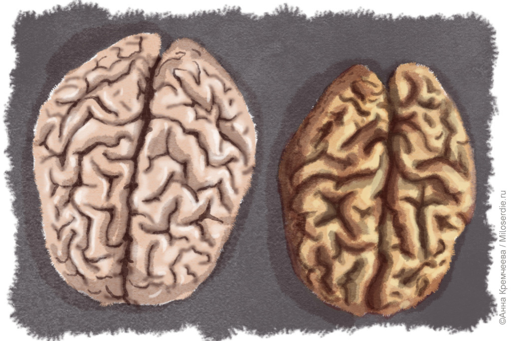 Слева – мозг здорового человека, справа – человека, болеющего Альцгеймером
