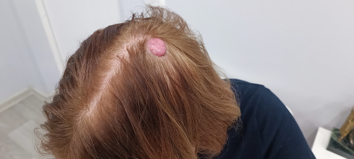 Цилиндрома, тюрбанная опухоль