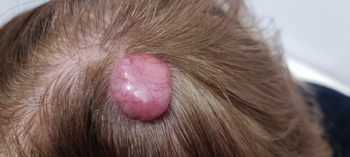 Цилиндрома, опухоль Шпиглера