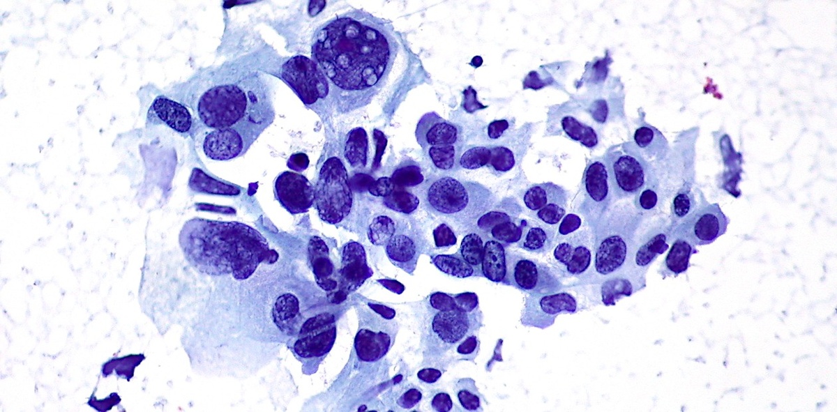 Немелкоклеточный рак легкого 