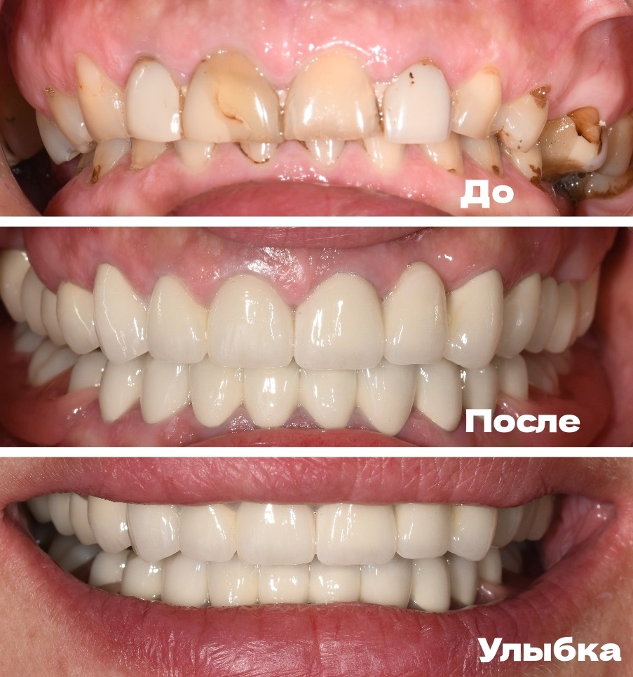 Металлокерамические коронки и съемный протез с нейлоновыми кламмерами для замещения жевательных зубов на нижней челюсти